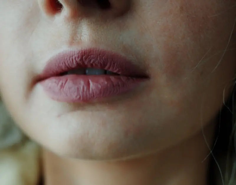 Close-up of dry, chapped lips