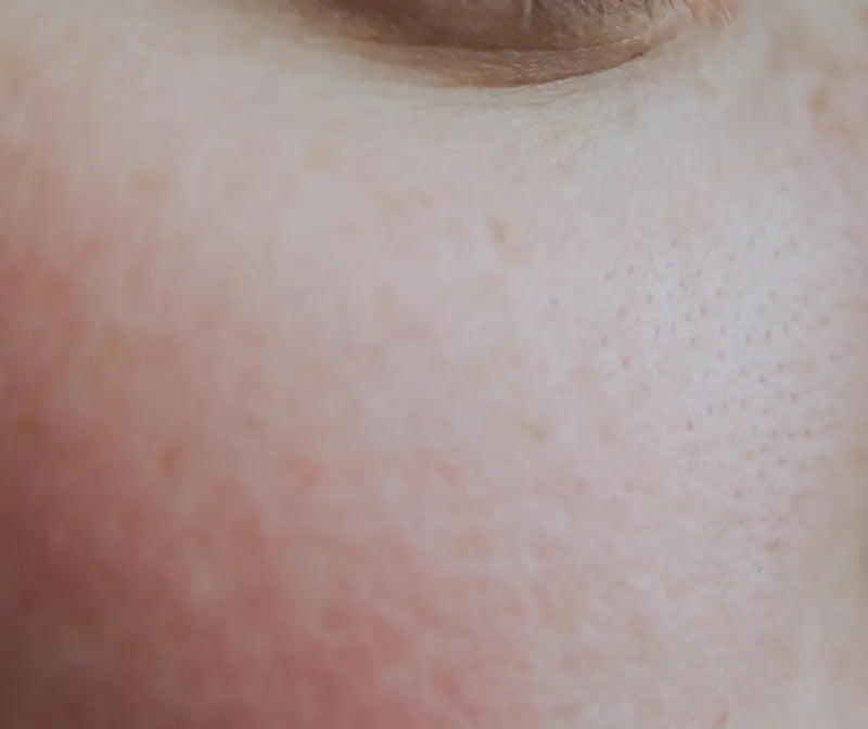 A flushed, freckled cheek