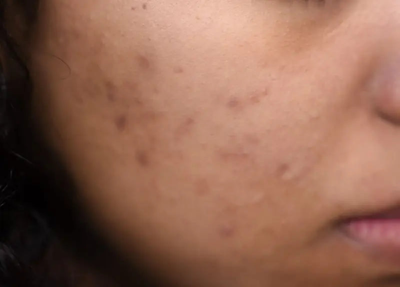 A cheek with marks left by old acne