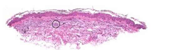 Histology of the untreated side: a thin band of tissue lying at the base of the frame.