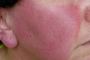 image of woman with rosacea