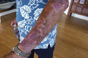 image of fragile skin on 65 yr old man's arm