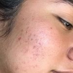 May 19 image of woman with acne scars after NME treatment