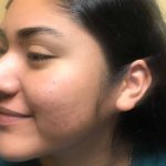 18 yo acne scars after aug 13