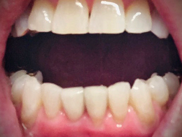 lower gums after 6 months